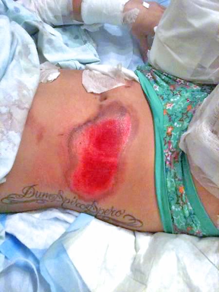 Name: rash1.jpg
Views: 211
Size: 38.2 KB