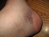 Bruise of the day-003.jpg