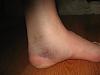 Bruise of the day-004.jpg