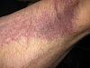 Bruise of the day-009.jpg