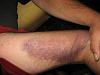 Bruise of the day-010.jpg